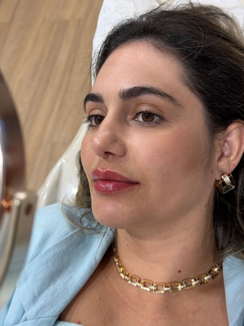 Paciente em três quartos, após harmonização facial