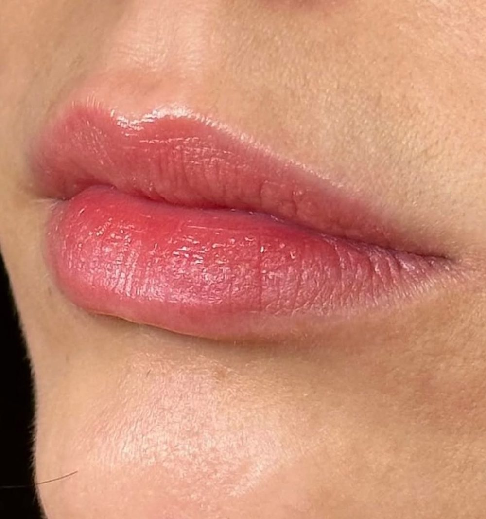 Close dos lábios de uma paciente após preenchimento labial