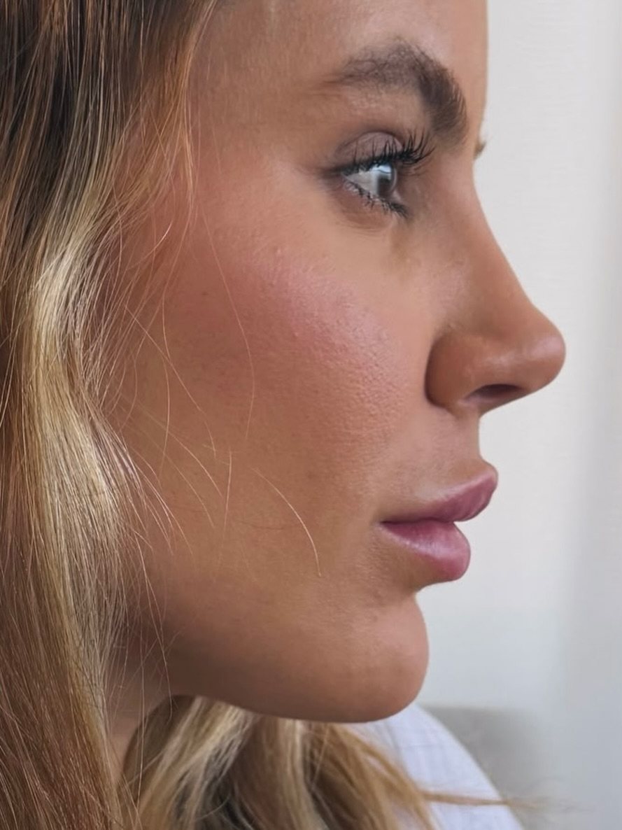 Paciente de perfil, com linhas de leitura dos terços do rosto